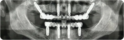 Implantes convencionais