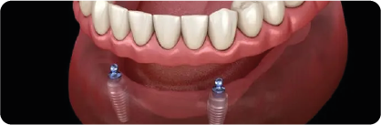 Implantes convencionais